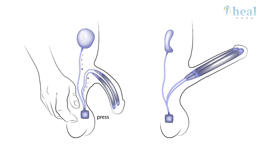 Three-Piece Penile Implant Cost in India