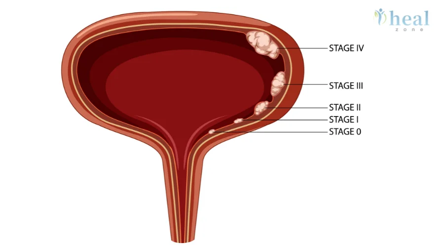 Glenn/Hemi-Fontan Procedure Cost in India