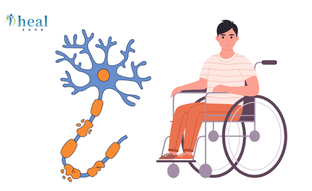 Affordable and Best Multiple Sclerosis Treatment in India for USA Patients