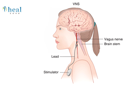 Power of the Vagus Nerve: How VNS Therapy Offers Hope for Epilepsy and Depression