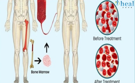 Bone Marrow Transplant (BMT): Procedure, Recovery, and Hope