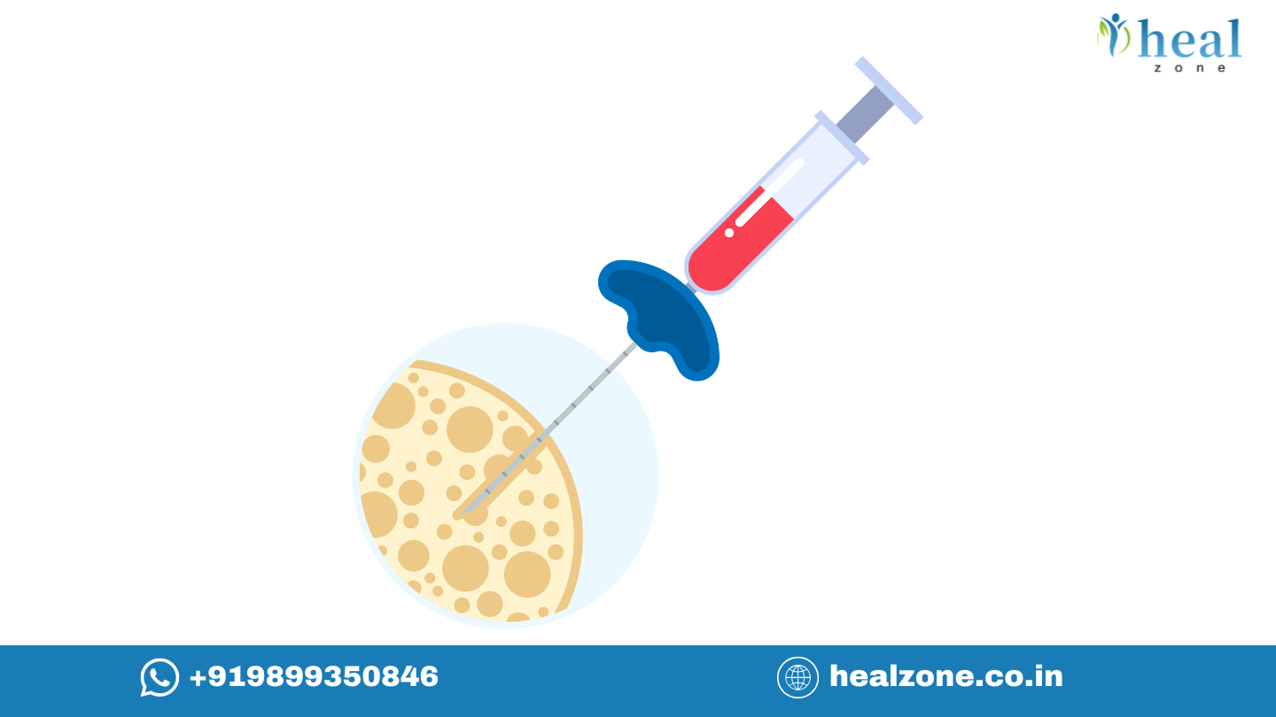 Half-Matched (Haploidentical) Transplant Explained: Cost, Success Rate & Treatment in India