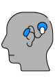 Cochlear Implant