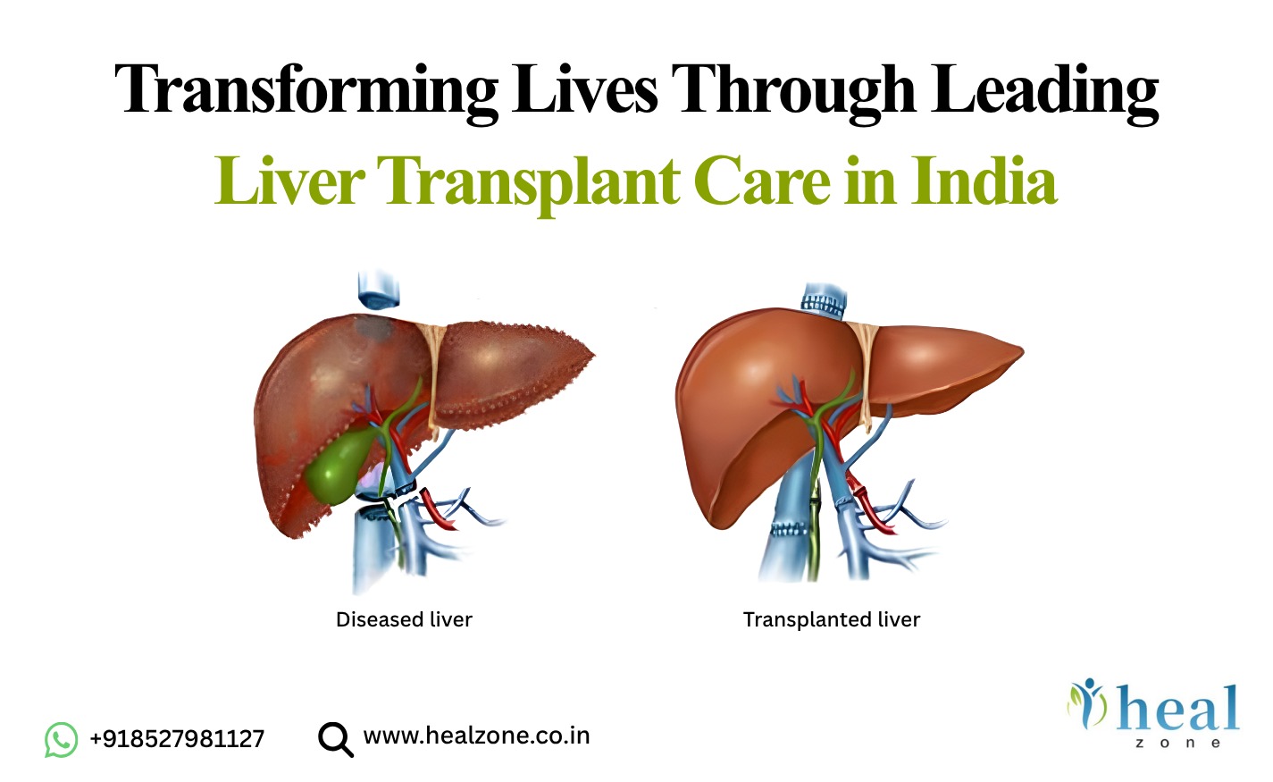 Liver Transplant Cost in India
